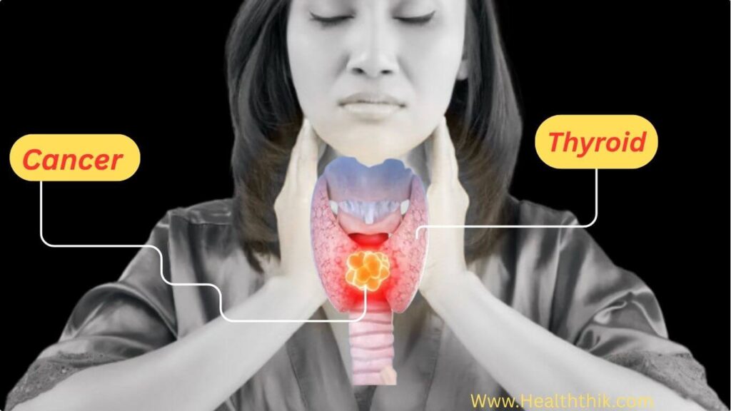  Thyroid Cancer 