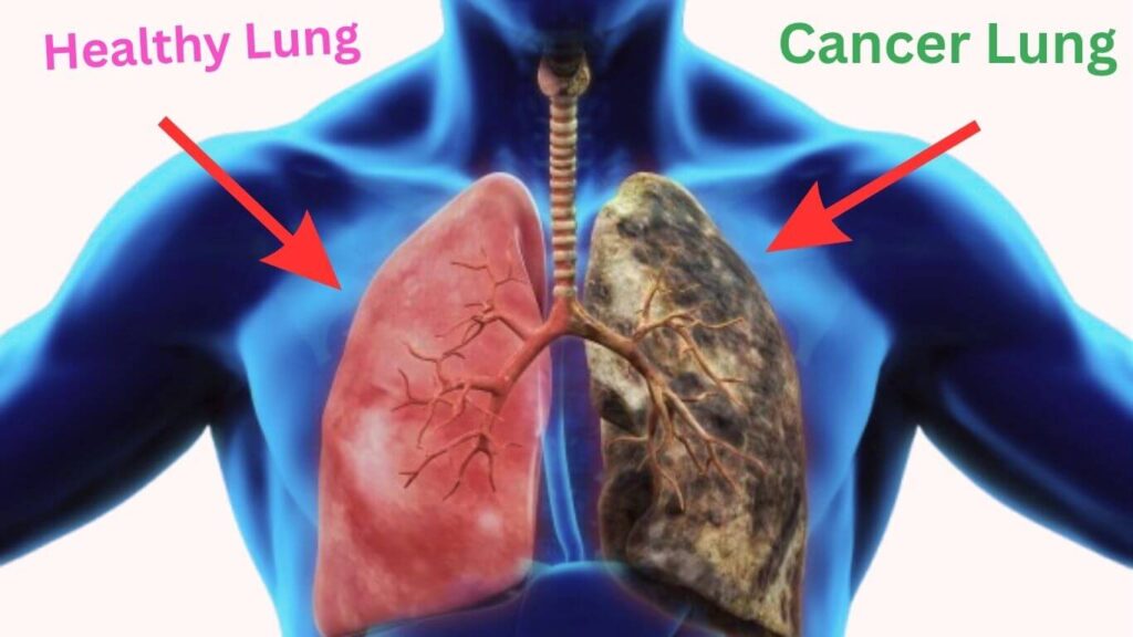 Healthy Lung and Cancer Lung