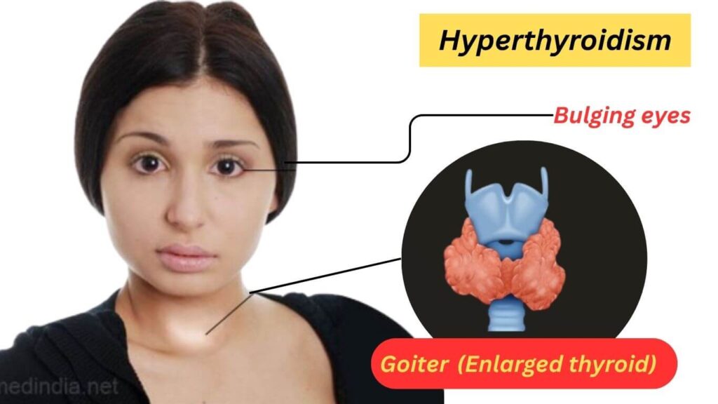 Hyperthyroidism