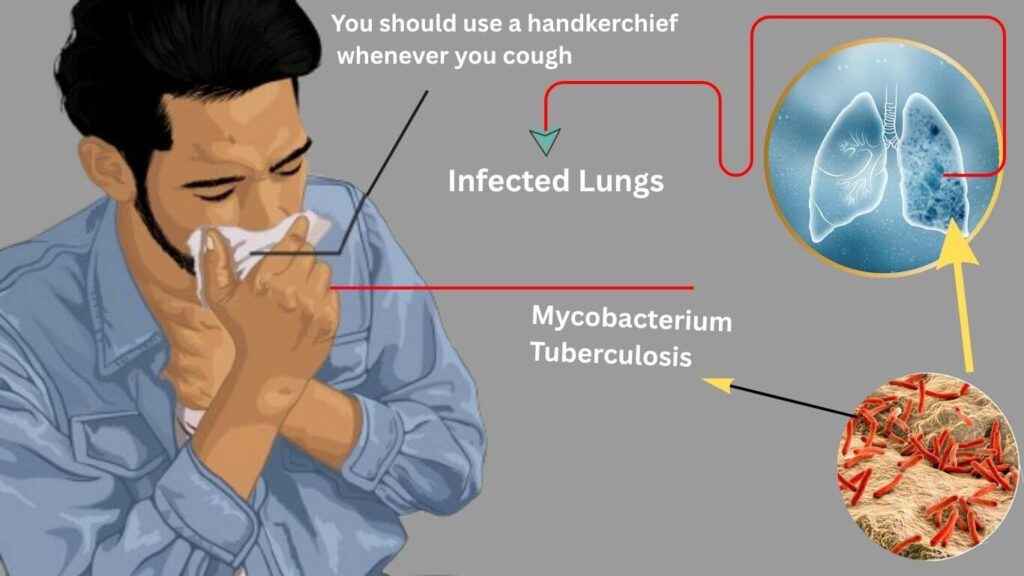 Pulmonary Tuberculosis