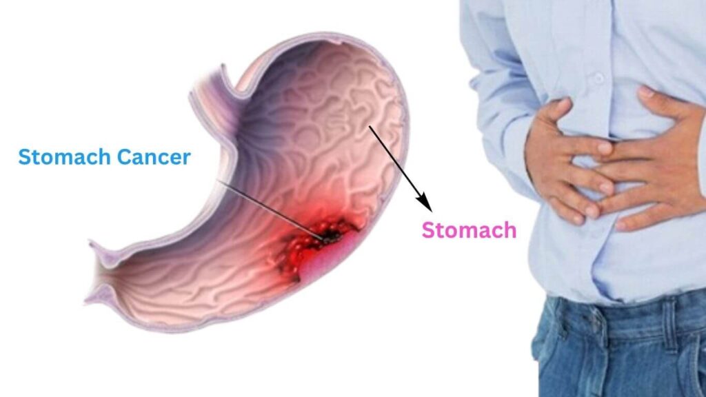 Stomach Cancer