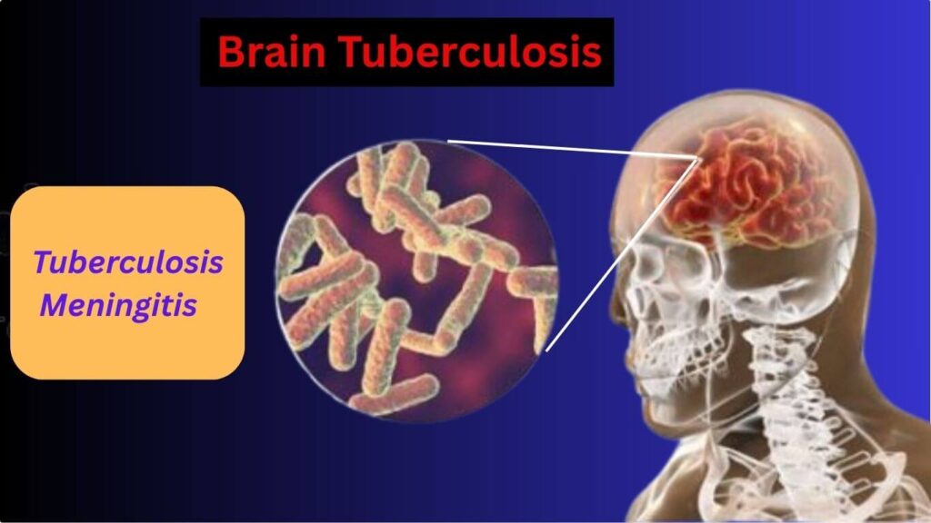 Brain Tuberculosis