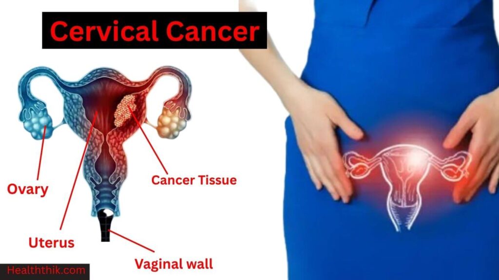 Cervical Cancer